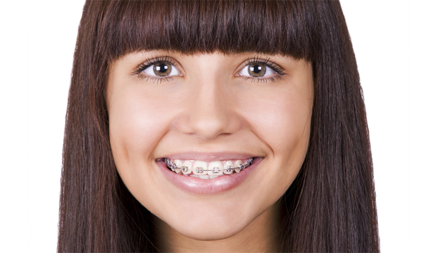 Orthodontie adolescent